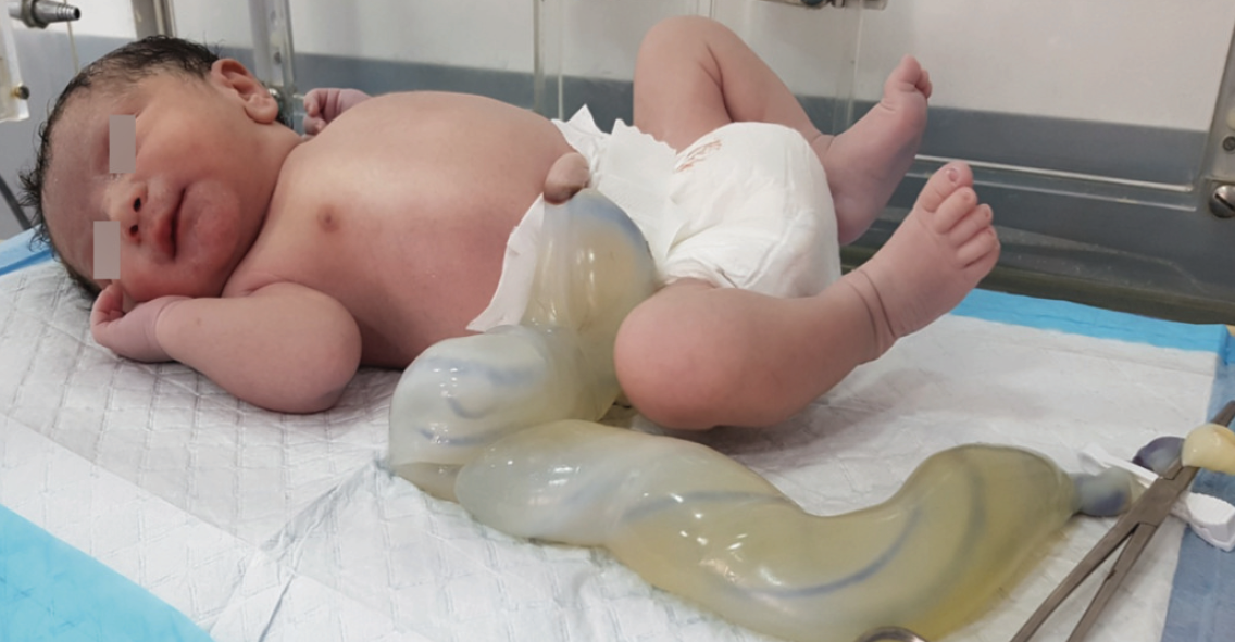 Une Malformation Congenitale Rare Le Cordon Ombilical Geant Sage Femme Pratique Une Malformation Congenitale Rare Le Cordon Ombilical Geant Sage Femme Pratique