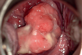 papillomavirus femme et grossesse