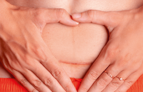 Déclenchement des utérus cicatriciels : quels antécédents ?