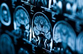 Savoir diagnostiquer le PRES syndrome 