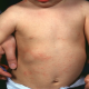 La Dermatite Atopique du nourrisson et du jeune enfant :  Les enjeux pour les sages-femmes