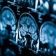 Savoir diagnostiquer le PRES syndrome 