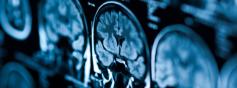 Savoir diagnostiquer le PRES syndrome 
