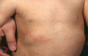 La Dermatite Atopique du nourrisson et du jeune enfant :  Les enjeux pour les sages-femmes