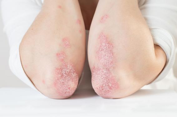 Quelle gestion en pratique du traitement du psoriasis pendant la grossesse ?